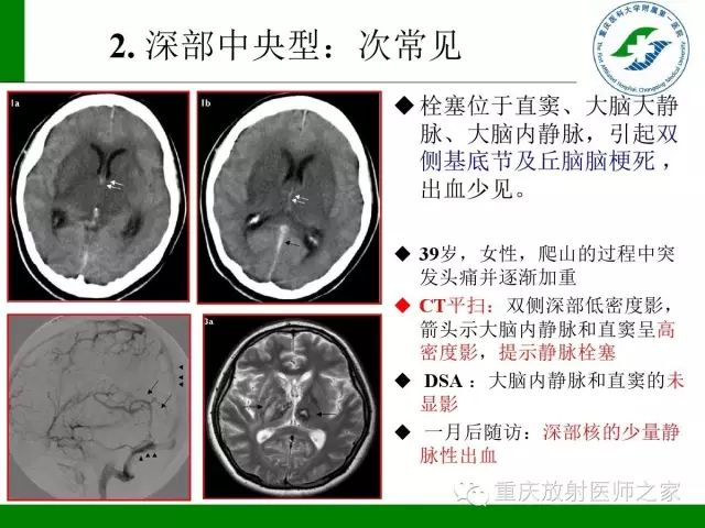 影像PPT - 【PPT】脑静脉解剖及相关疾病影像学诊断-24