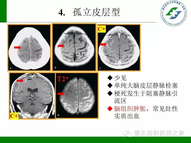 影像PPT - 【PPT】脑静脉解剖及相关疾病影像学诊断-28
