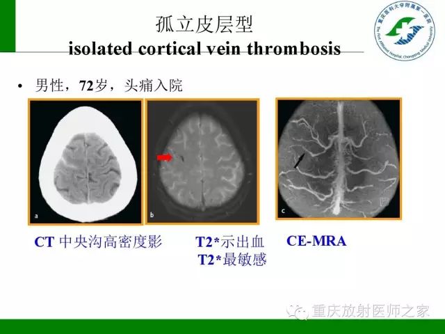 影像PPT - 【PPT】脑静脉解剖及相关疾病影像学诊断-29