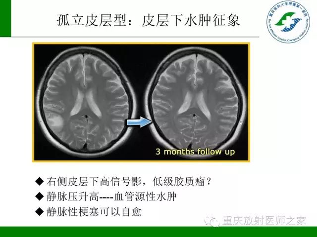 影像PPT - 【PPT】脑静脉解剖及相关疾病影像学诊断-30
