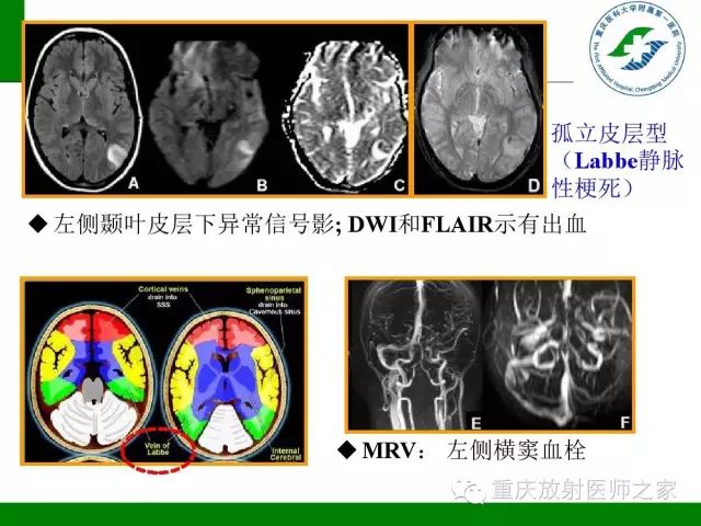 影像PPT - 【PPT】脑静脉解剖及相关疾病影像学诊断-32