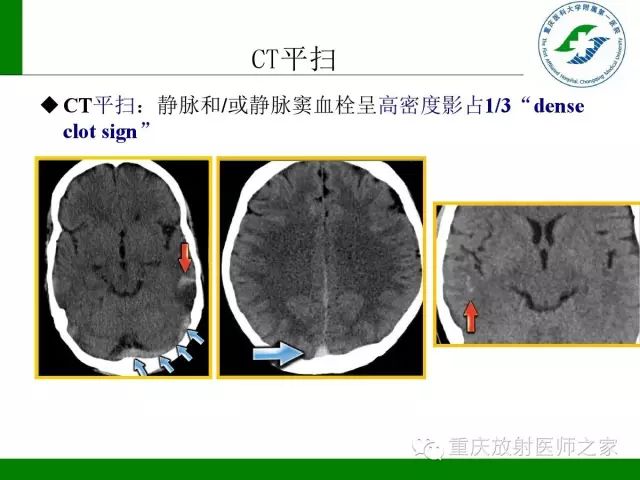 影像PPT - 【PPT】脑静脉解剖及相关疾病影像学诊断-34