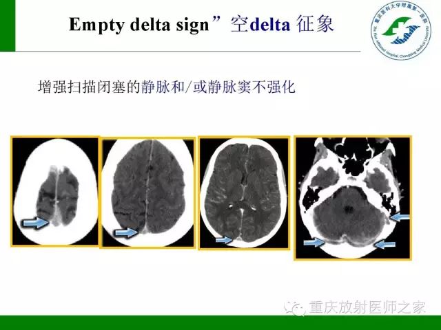 影像PPT - 【PPT】脑静脉解剖及相关疾病影像学诊断-35