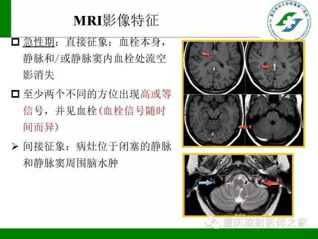 影像PPT - 【PPT】脑静脉解剖及相关疾病影像学诊断-36