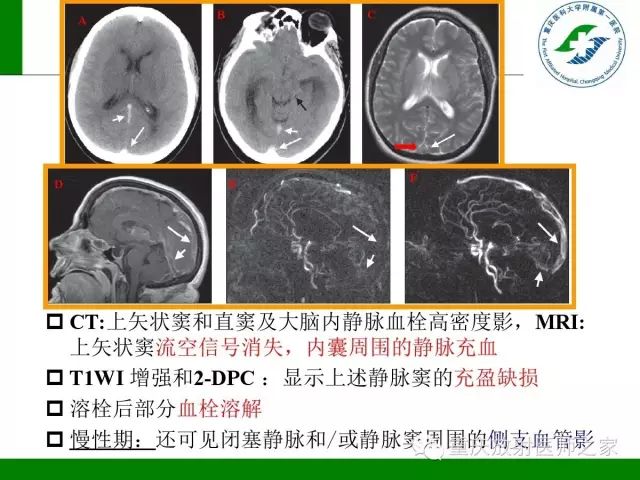 影像PPT - 【PPT】脑静脉解剖及相关疾病影像学诊断-37