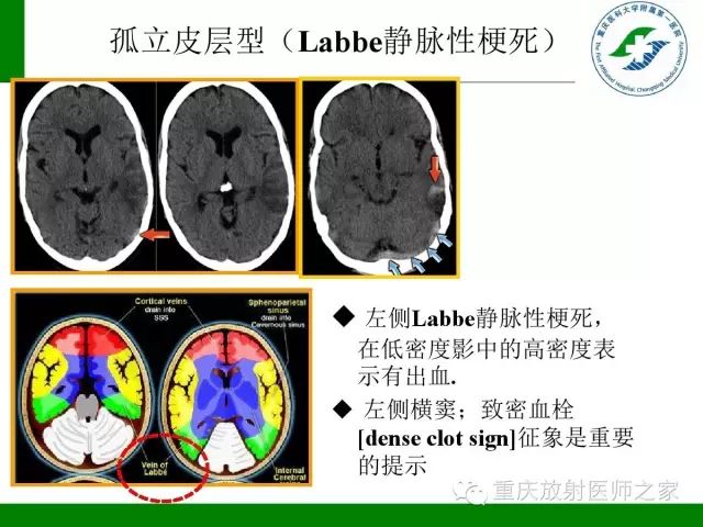 影像PPT - 【PPT】脑静脉解剖及相关疾病影像学诊断-31