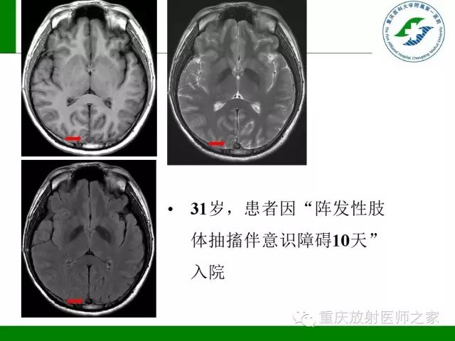 影像PPT - 【PPT】脑静脉解剖及相关疾病影像学诊断-38