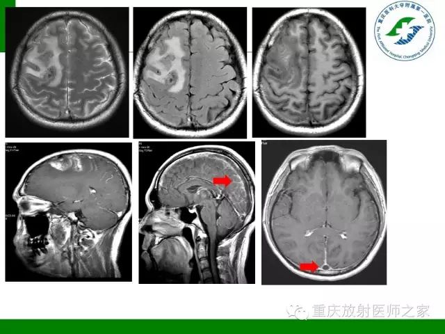 影像PPT - 【PPT】脑静脉解剖及相关疾病影像学诊断-39