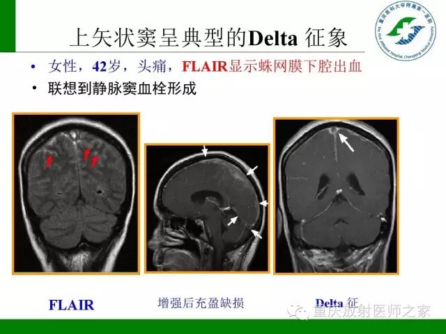 影像PPT - 【PPT】脑静脉解剖及相关疾病影像学诊断-41