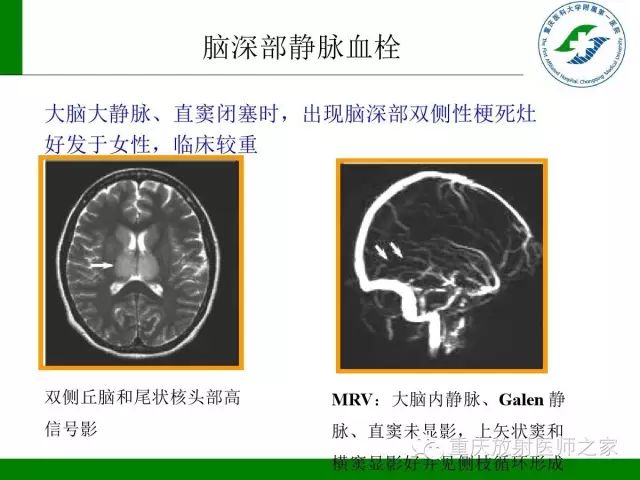 影像PPT - 【PPT】脑静脉解剖及相关疾病影像学诊断-43