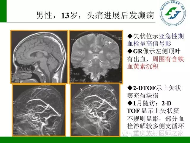 影像PPT - 【PPT】脑静脉解剖及相关疾病影像学诊断-42