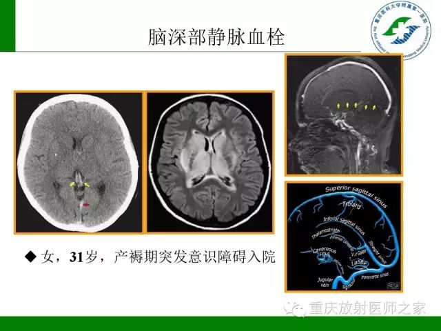 影像PPT - 【PPT】脑静脉解剖及相关疾病影像学诊断-44