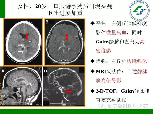 影像PPT - 【PPT】脑静脉解剖及相关疾病影像学诊断-45