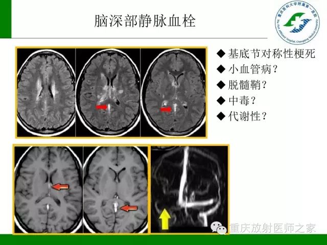 影像PPT - 【PPT】脑静脉解剖及相关疾病影像学诊断-40