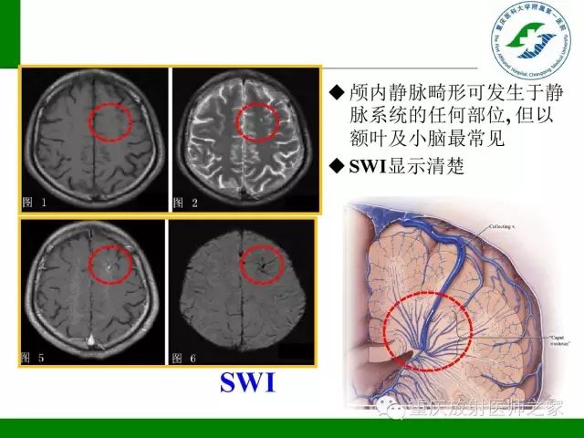 影像PPT - 【PPT】脑静脉解剖及相关疾病影像学诊断-50