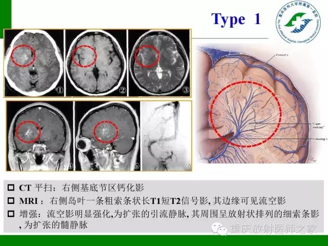 影像PPT - 【PPT】脑静脉解剖及相关疾病影像学诊断-49