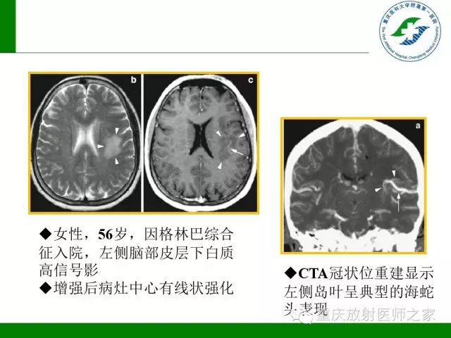 影像PPT - 【PPT】脑静脉解剖及相关疾病影像学诊断-52