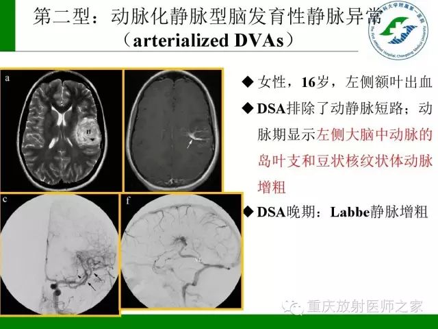 影像PPT - 【PPT】脑静脉解剖及相关疾病影像学诊断-53