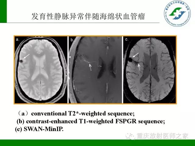 影像PPT - 【PPT】脑静脉解剖及相关疾病影像学诊断-54
