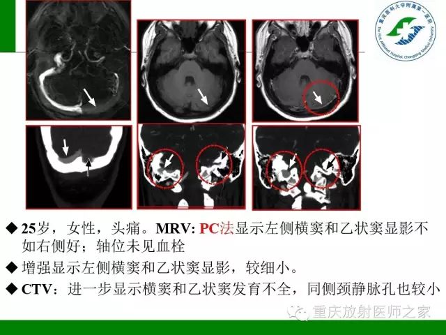 影像PPT - 【PPT】脑静脉解剖及相关疾病影像学诊断-58