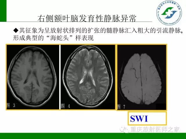 影像PPT - 【PPT】脑静脉解剖及相关疾病影像学诊断-51