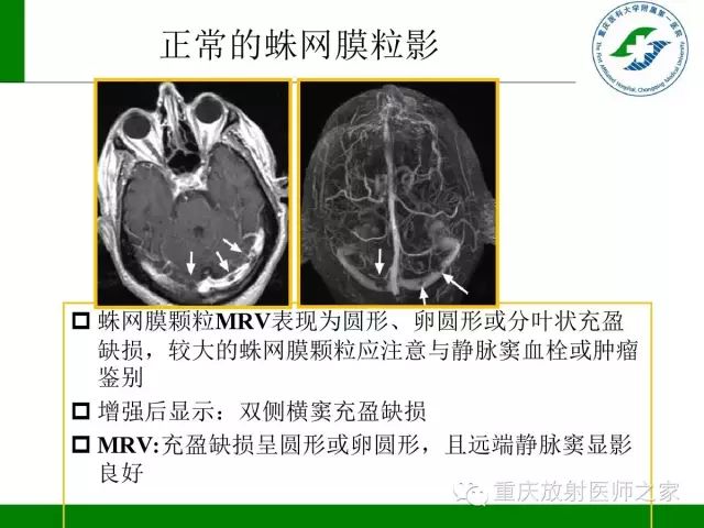 影像PPT - 【PPT】脑静脉解剖及相关疾病影像学诊断-59
