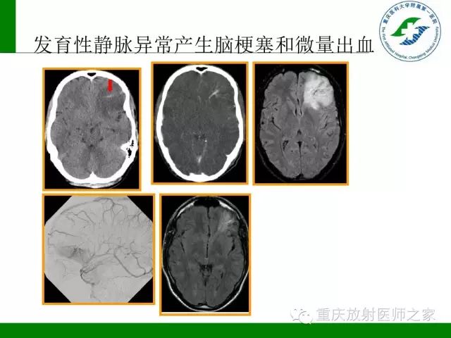 影像PPT - 【PPT】脑静脉解剖及相关疾病影像学诊断-55