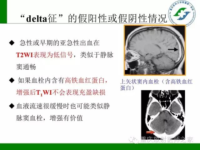影像PPT - 【PPT】脑静脉解剖及相关疾病影像学诊断-60