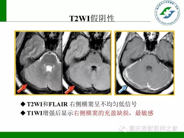 影像PPT - 【PPT】脑静脉解剖及相关疾病影像学诊断-61
