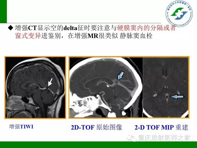 影像PPT - 【PPT】脑静脉解剖及相关疾病影像学诊断-62