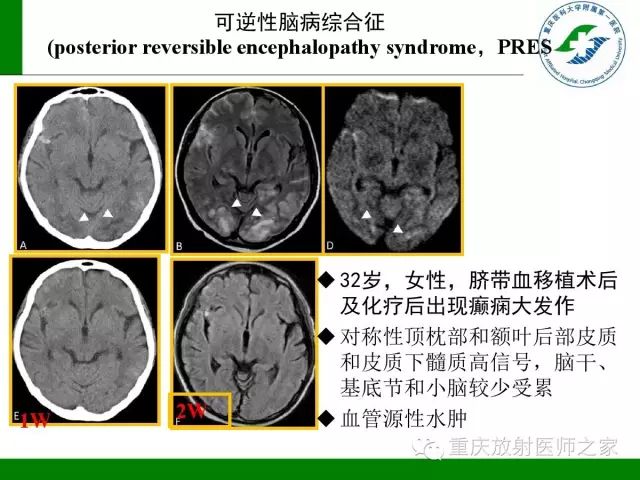 影像PPT - 【PPT】脑静脉解剖及相关疾病影像学诊断-64