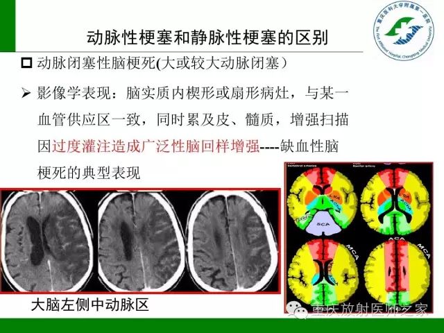 影像PPT - 【PPT】脑静脉解剖及相关疾病影像学诊断-65