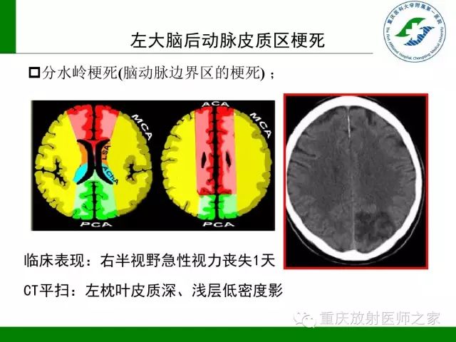 影像PPT - 【PPT】脑静脉解剖及相关疾病影像学诊断-66