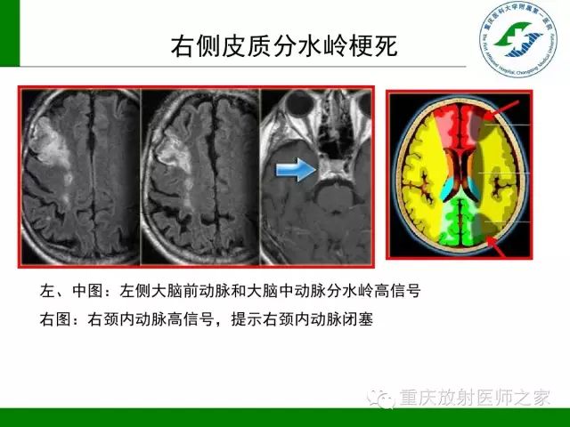影像PPT - 【PPT】脑静脉解剖及相关疾病影像学诊断-67