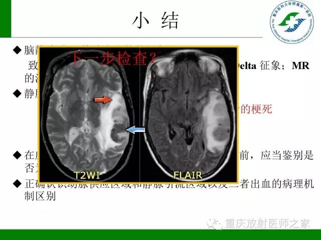 影像PPT - 【PPT】脑静脉解剖及相关疾病影像学诊断-68