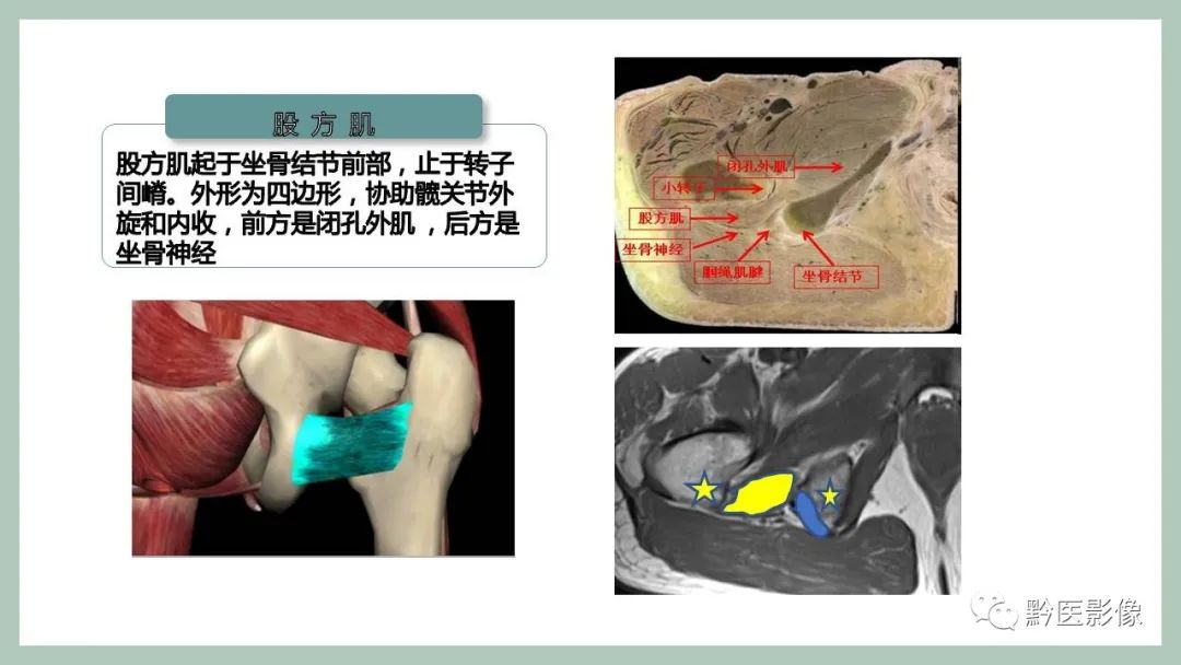 影像PPT - 【PPT】坐骨股骨撞击综合征MR影像诊断-3