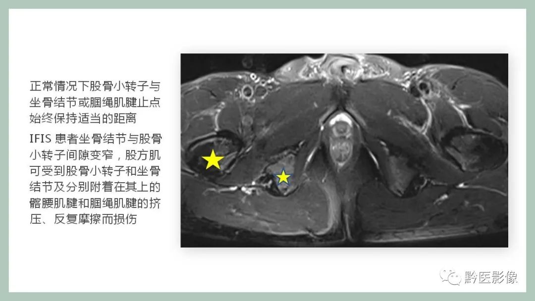 影像PPT - 【PPT】坐骨股骨撞击综合征MR影像诊断-4