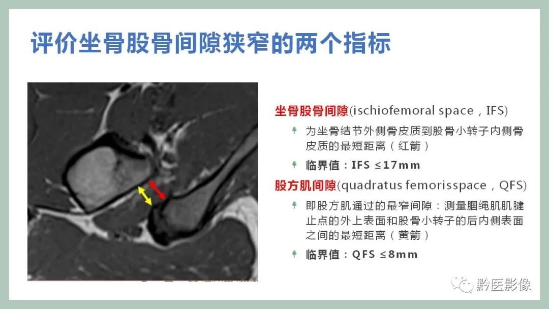 影像PPT - 【PPT】坐骨股骨撞击综合征MR影像诊断-8