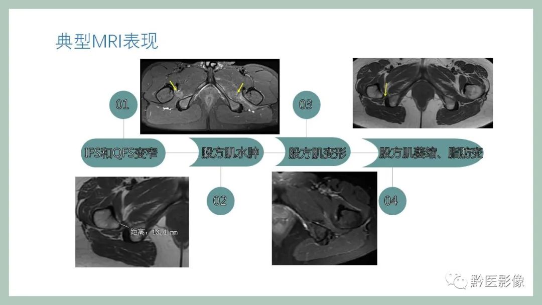 影像PPT - 【PPT】坐骨股骨撞击综合征MR影像诊断-9