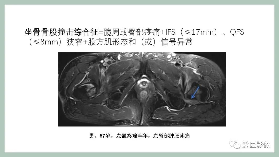影像PPT - 【PPT】坐骨股骨撞击综合征MR影像诊断-10
