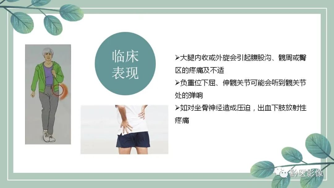 影像PPT - 【PPT】坐骨股骨撞击综合征MR影像诊断-6