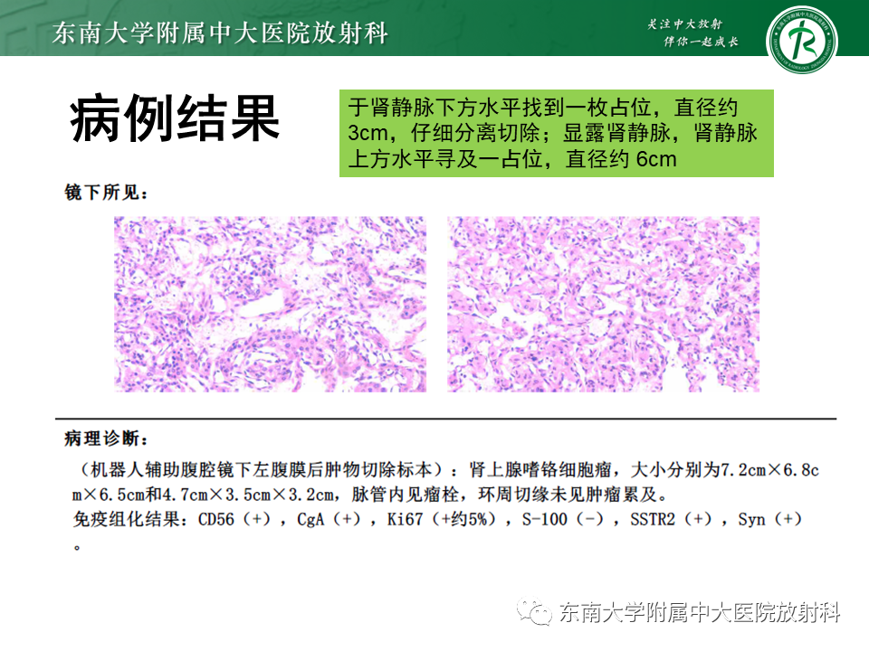 影像PPT - 【PPT】肾上腺嗜铬细胞瘤的影像诊断-2 影像PPT - 【PPT】肾上腺嗜铬细胞瘤的影像诊断-2