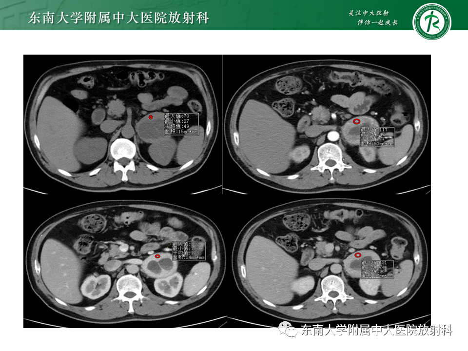 影像PPT - 【PPT】肾上腺嗜铬细胞瘤的影像诊断-14 影像PPT - 【PPT】肾上腺嗜铬细胞瘤的影像诊断-14