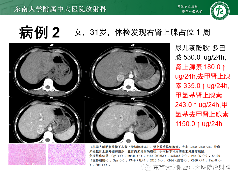 影像PPT - 【PPT】肾上腺嗜铬细胞瘤的影像诊断-16 影像PPT - 【PPT】肾上腺嗜铬细胞瘤的影像诊断-16