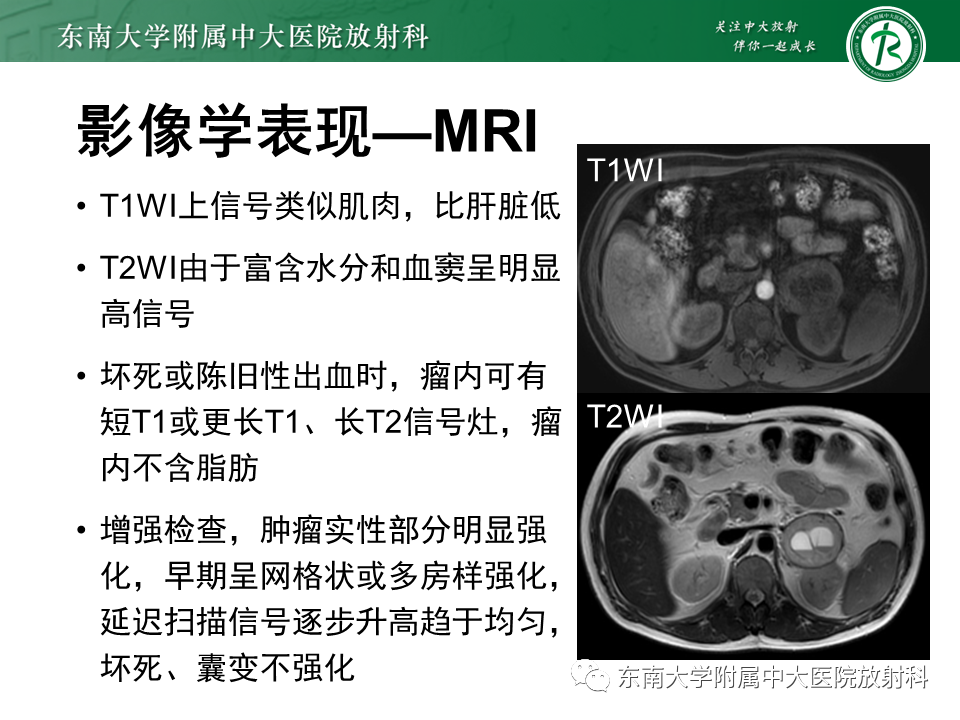 影像PPT - 【PPT】肾上腺嗜铬细胞瘤的影像诊断-15 影像PPT - 【PPT】肾上腺嗜铬细胞瘤的影像诊断-15