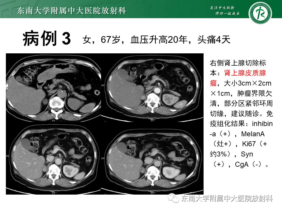 影像PPT - 【PPT】肾上腺嗜铬细胞瘤的影像诊断-20 影像PPT - 【PPT】肾上腺嗜铬细胞瘤的影像诊断-20