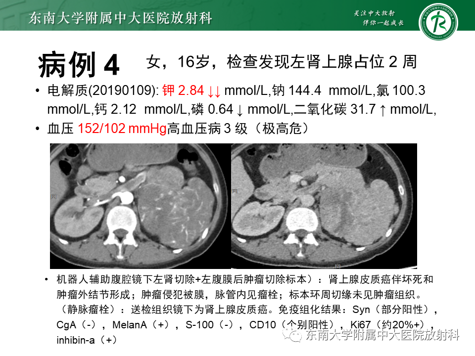 影像PPT - 【PPT】肾上腺嗜铬细胞瘤的影像诊断-24 影像PPT - 【PPT】肾上腺嗜铬细胞瘤的影像诊断-24