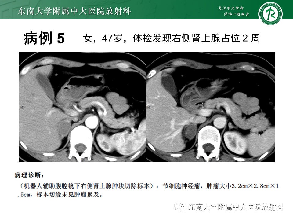 影像PPT - 【PPT】肾上腺嗜铬细胞瘤的影像诊断-26 影像PPT - 【PPT】肾上腺嗜铬细胞瘤的影像诊断-26