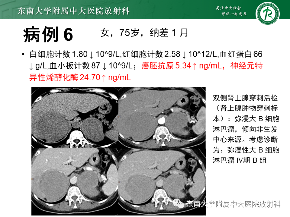 影像PPT - 【PPT】肾上腺嗜铬细胞瘤的影像诊断-31 影像PPT - 【PPT】肾上腺嗜铬细胞瘤的影像诊断-31