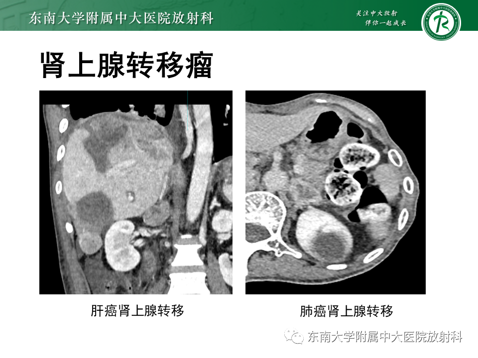 影像PPT - 【PPT】肾上腺嗜铬细胞瘤的影像诊断-33 影像PPT - 【PPT】肾上腺嗜铬细胞瘤的影像诊断-33